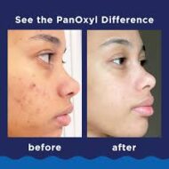 PanOxyl Acne Foaming Wash Benzoyl Peroxide 10% Maximum Strength – Image 8