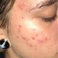 PanOxyl Acne Foaming Wash Benzoyl Peroxide 10% Maximum Strength – Image 7