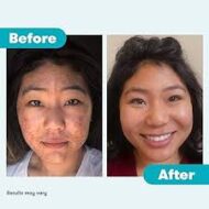 PanOxyl Acne Foaming Wash Benzoyl Peroxide 10% Maximum Strength – Image 5