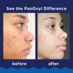 PANOXYL - Acne Foaming Wash Benzoyl Peroxide 4% Daily Control 170g – Image 3